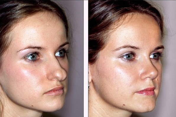 Methods for correcting keloid scars after rhinoplasty