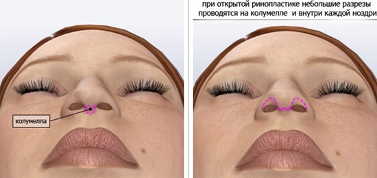 Methods for correcting keloid scars after rhinoplasty