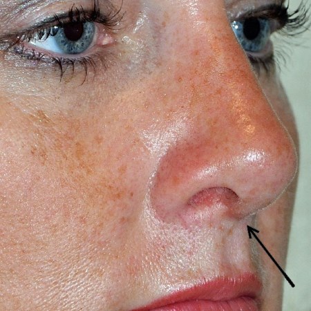 Methods for correcting keloid scars after rhinoplasty