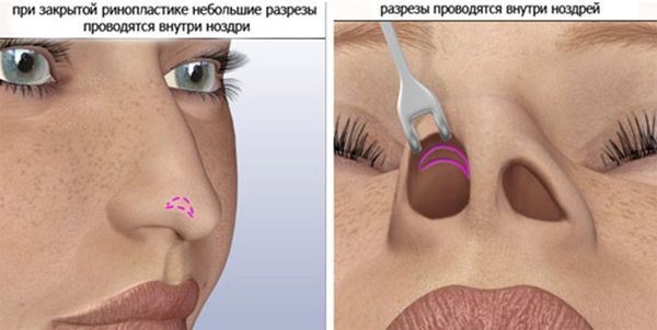 Methods for correcting keloid scars after rhinoplasty