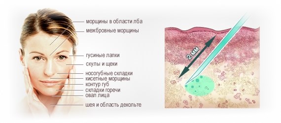 Biorevitalization for the face. Techniques, stages of the course, features of the procedure