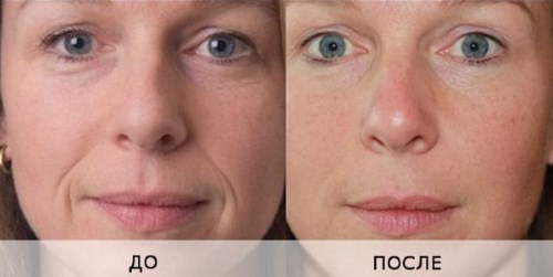 Biorevitalization for the face. Techniques, stages of the course, features of the procedure