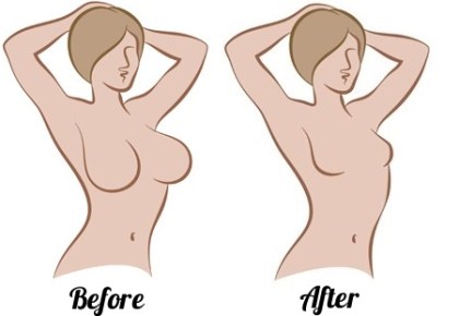 Breast reduction surgery. Photos, videos, prices, reviews