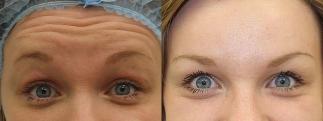 Relatox or Botox - which is better? Beauty Injection Injection Comparison