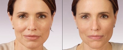 Relatox or Botox - which is better? Beauty Injection Injection Comparison