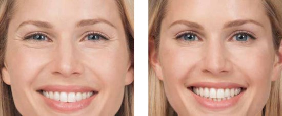 Relatox or Botox - which is better? Beauty Injection Injection Comparison