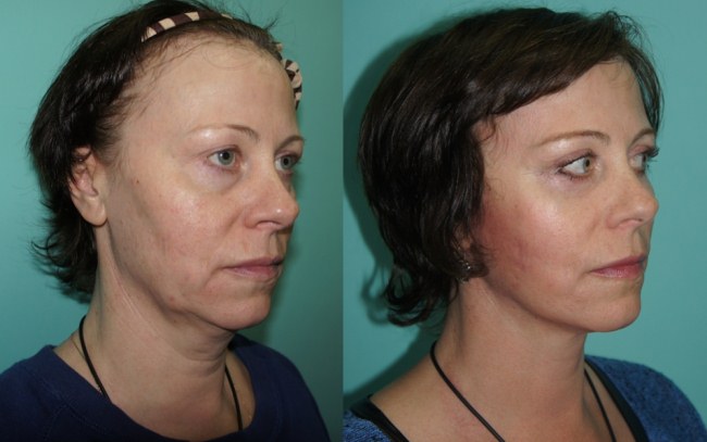 Hyaluronic acid injections for the face (lips, under the eyes, forehead). Before and after photos