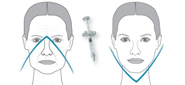 Hyaluronic acid injections for the face (lips, under the eyes, forehead). Before and after photos