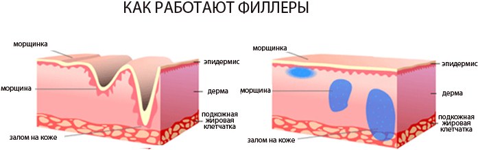 Hyaluronic acid injections for the face (lips, under the eyes, forehead). Before and after photos