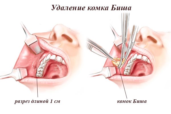 Lumps of Bisha. What is it, how is it removed, the operation, how to clean it at home