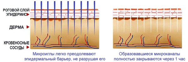 Facial mesotherapy - what is it. Photos before and after, reviews, at what age