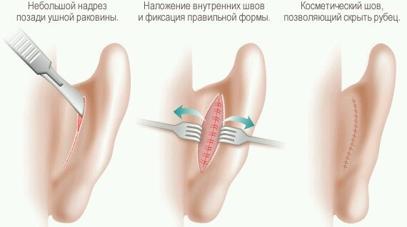 Plastic surgery on the ears so that they do not stick out. Price, photo, video