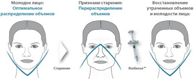 Radiesse in the cheekbones. Photos before and after the procedure, price, reviews of cosmetologists