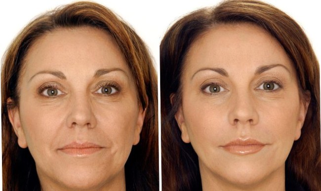 Radiesse in the cheekbones. Photos before and after the procedure, price, reviews of cosmetologists