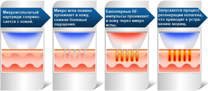 Rf face lifting - what is it, before and after photos, consequences, doctors' reviews