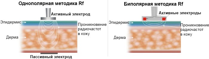 Rf face lifting - what is it, before and after photos, consequences, doctors' reviews