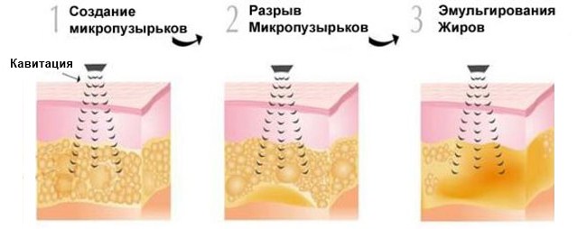 Rf face lifting - what is it, before and after photos, consequences, doctors' reviews