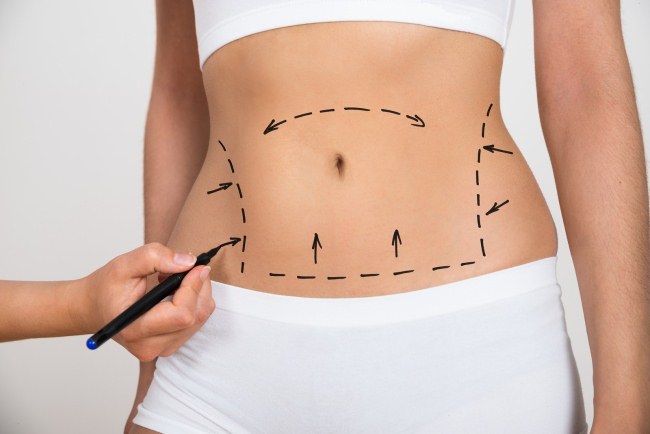 Body liposuction. How much, price, before and after photos, video, reviews