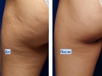 Cavitation - what it is, how fat is removed. Before and after photos