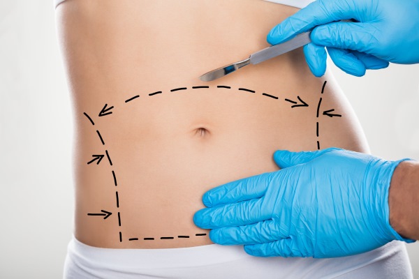 Abdominoplasty (tummy tuck). What is it, price, before and after photos, video, reviews