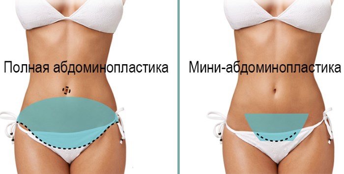 Abdominoplasty (tummy tuck). What is it, price, before and after photos, video, reviews