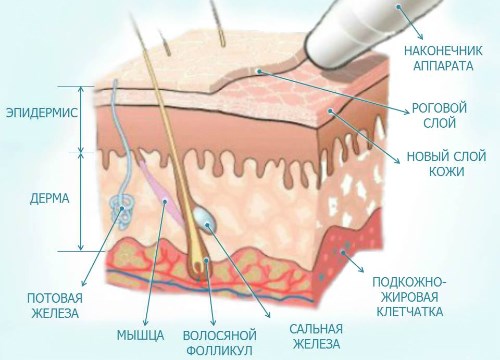 Diamond peeling for facial skin. What is it, indications, apparatus, price of the procedure, photo