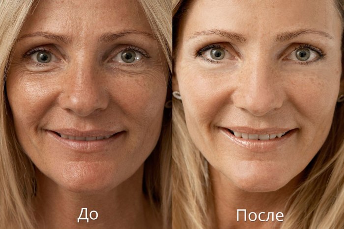 Biorevitalization is a facial rejuvenation procedure. Preparations, price, reviews, before and after photos