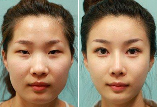 Blepharoplasty - what is it, how it goes, before and after photos