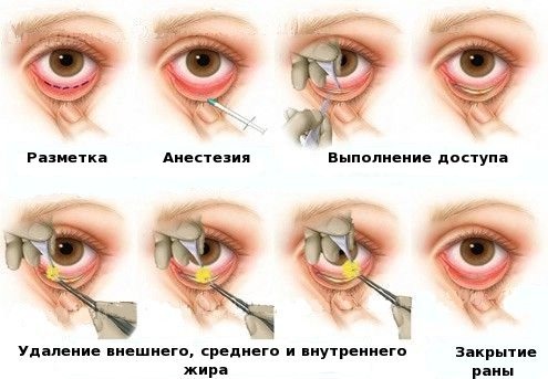 Blepharoplasty - what is it, how it goes, before and after photos