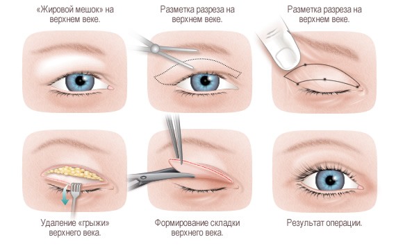 Blepharoplasty - what is it, how it goes, before and after photos