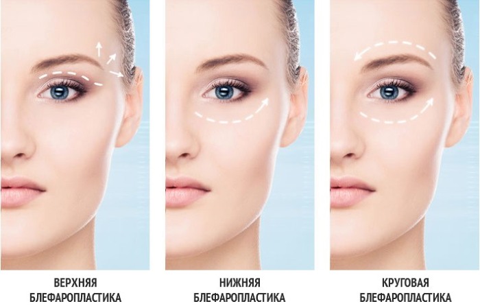 Blepharoplasty - what is it, how it goes, before and after photos