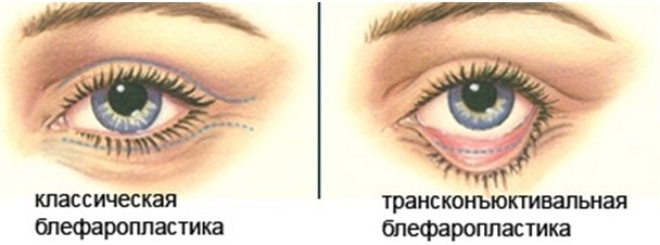 Blepharoplasty - what is it, how it goes, before and after photos