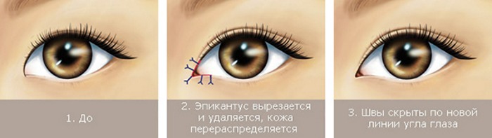 Blepharoplasty - what is it, how it goes, before and after photos