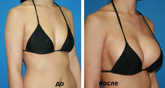 What is lipofilling? Lipofilling of the face, breasts, buttocks, price, before and after photos