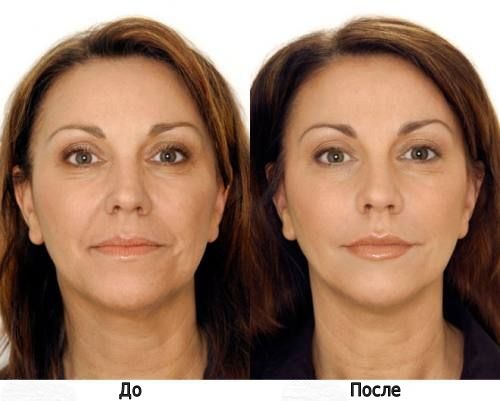 What is Microcurrent Facial Therapy