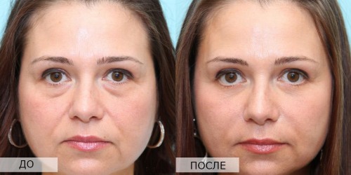 What is Microcurrent Facial Therapy