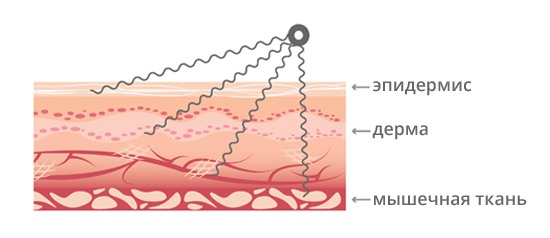 What is Microcurrent Facial Therapy