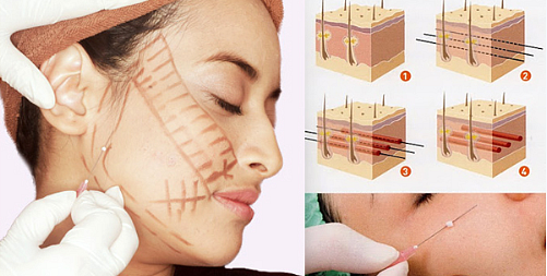 Facelift for the face - exercises, surgery, facelift