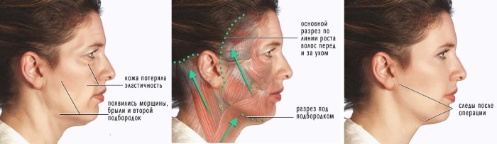 Facelift for the face - exercises, surgery, facelift