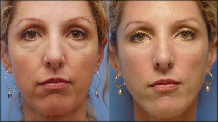 Facelift for the face - exercises, surgery, facelift