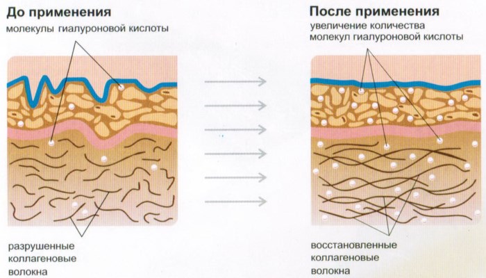 Fillers for the face. What is it in cosmetology, which is better, photos before, after the procedure