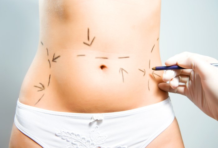 Come nascondere le smagliature sullo stomaco: con l'aiuto di procedure, tatuaggi, laser, foto