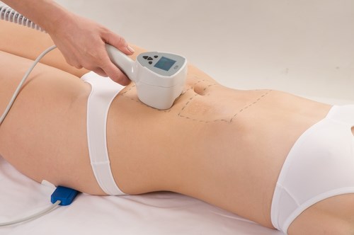 Come nascondere le smagliature sullo stomaco: con l'aiuto di procedure, tatuaggi, laser, foto