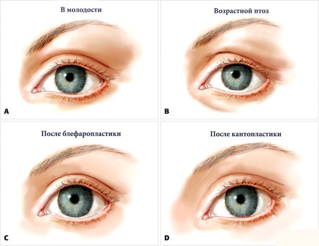 Cantoplasty - what is it, before and after photos, price. External, medial surgery