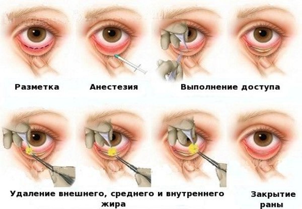 Cantoplasty - what is it, before and after photos, price. External, medial surgery