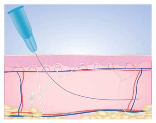 Cannula in cosmetology and medicine