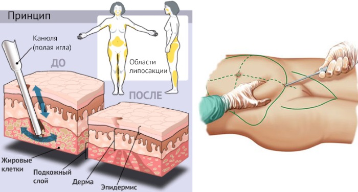 Cannula in cosmetologia e medicina