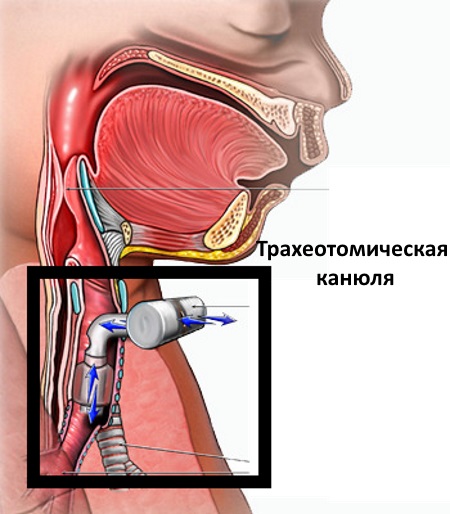 Cannula in cosmetologia e medicina