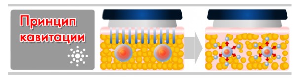 Cavitation - what it is, how fat is removed. Before and after photos