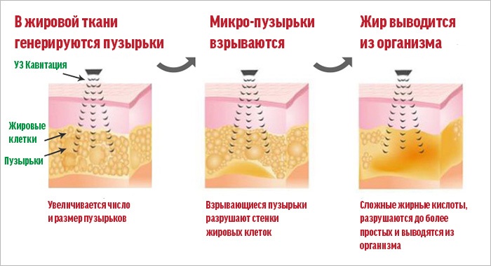 Cavitation - what it is, how fat is removed. Before and after photos